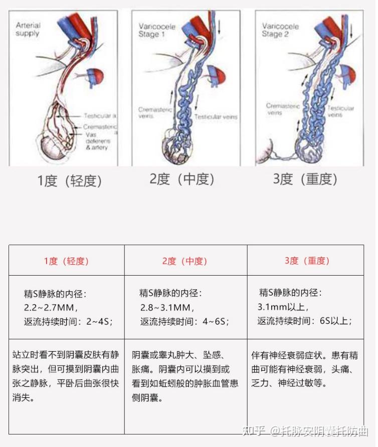 精索靜脈曲張三個程度圖詳解，精索靜脈曲張三個程度詳解圖解