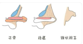 正規(guī)包莖手術(shù)費用詳解，正規(guī)包莖手術(shù)費用全面解析