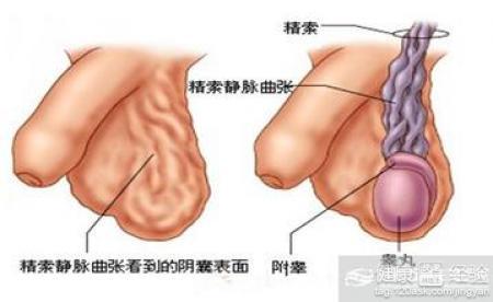 精索靜脈曲張可以自愈嗎？解析與探討，精索靜脈曲張能否自愈？解析與探討