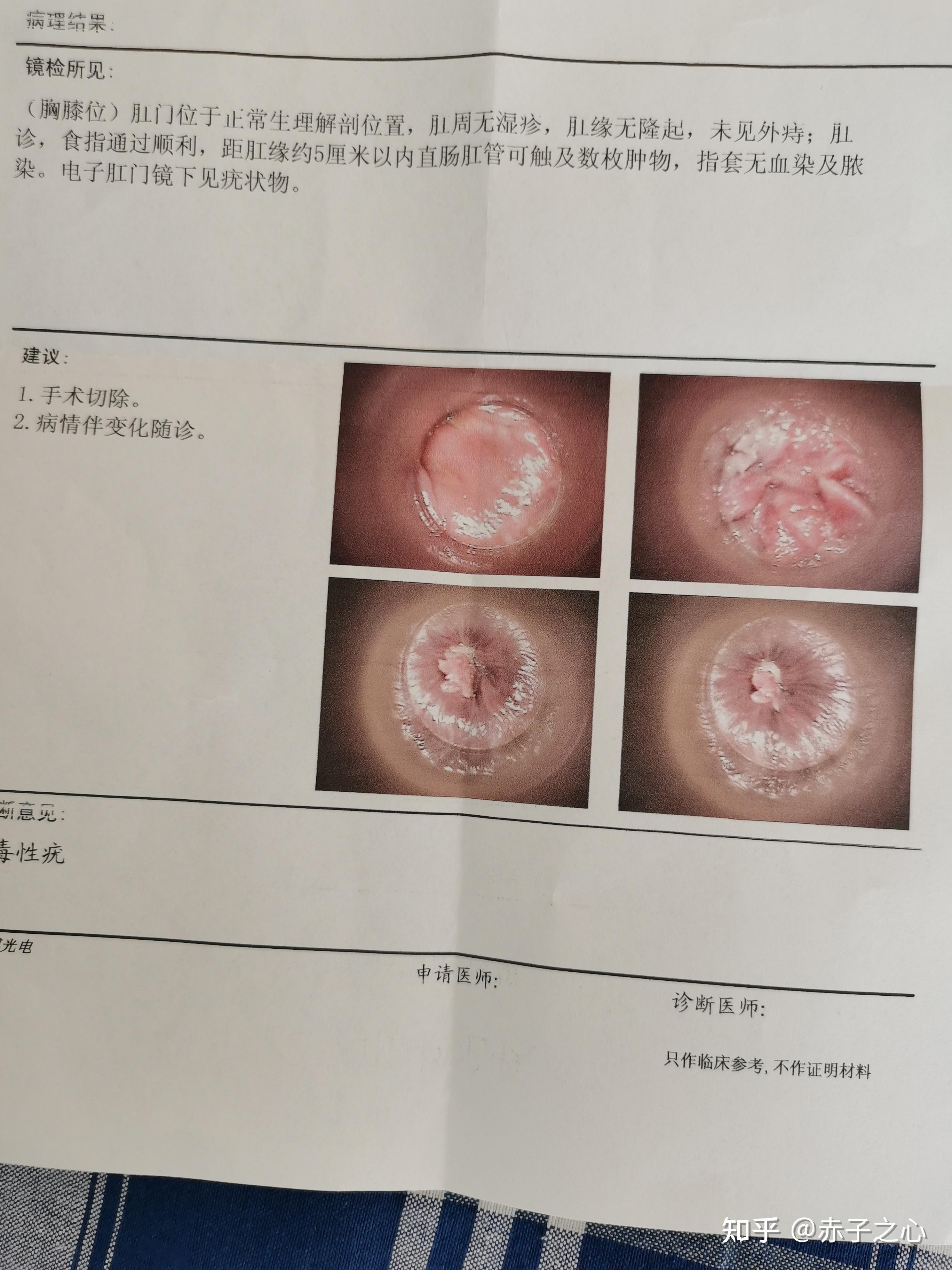 患者尖銳治愈的真實過程，患者尖銳濕癥的治愈之路